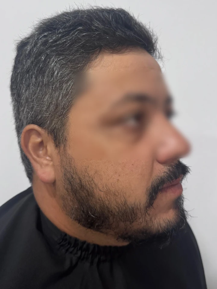 Antes Transplante de Barba