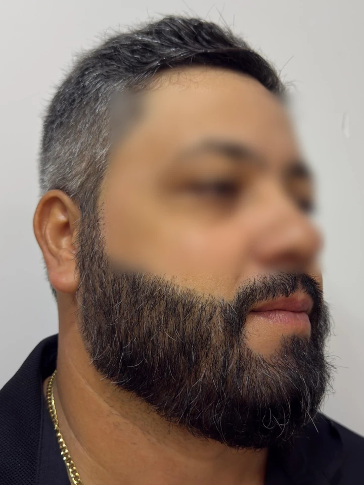 Depois Transplante de Barba